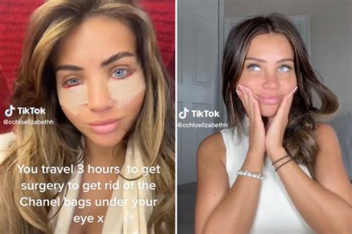 Brides-to-Be Are Getting Plastic Surgery to Obtain the “Markle Sparkle” Before Their Weddings! (EXCLUSIVE)