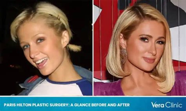 Did Paris Hilton Get Plastic Surgery? The Heiress’ Quotes about Botox, Going Under the Knife and More